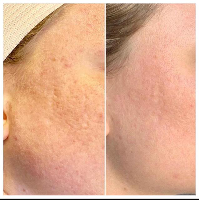 Aerolase for Acne Scarring in Vienna VA | Sechoir Beauty Bar