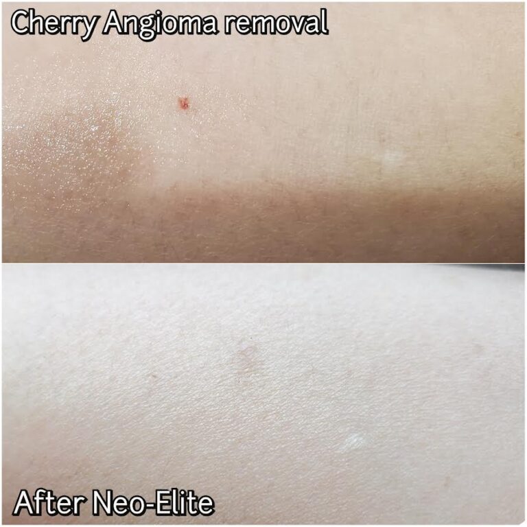 Aerolase for Cherry Angioma in Vienna VA | Sechoir Beauty Bar