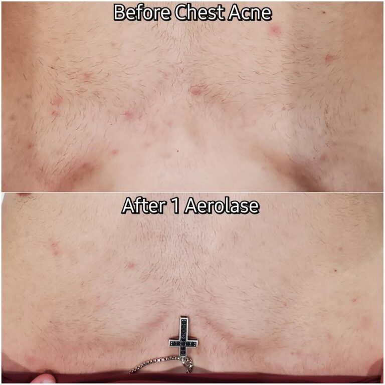 Aerolase for Chest Acne in Vienna VA | Sechoir Beauty Bar