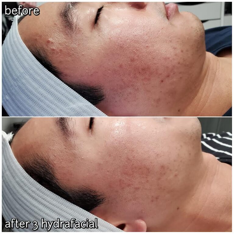 Hydrafacial Before and After