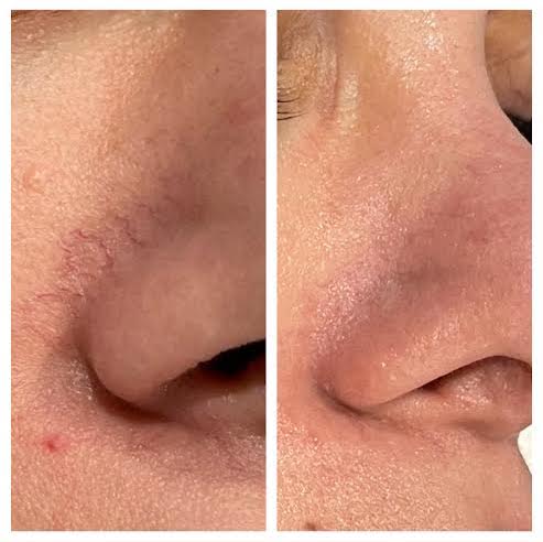 BBL for Broken Capillaries in Vienna VA | Sechoir Beauty Bar