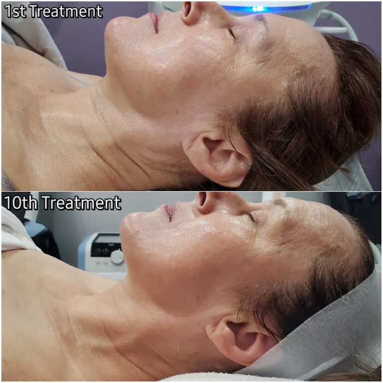 Aerolase Before and After