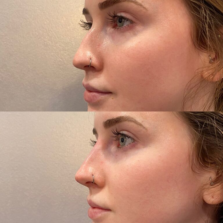 Liquid Rhinoplasty Before and After