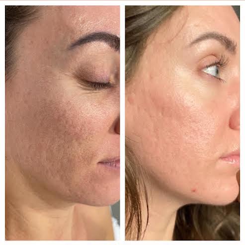 Microneedling for Acne Scars and Skin | Sechoir Beauty Bar in Vienna VA