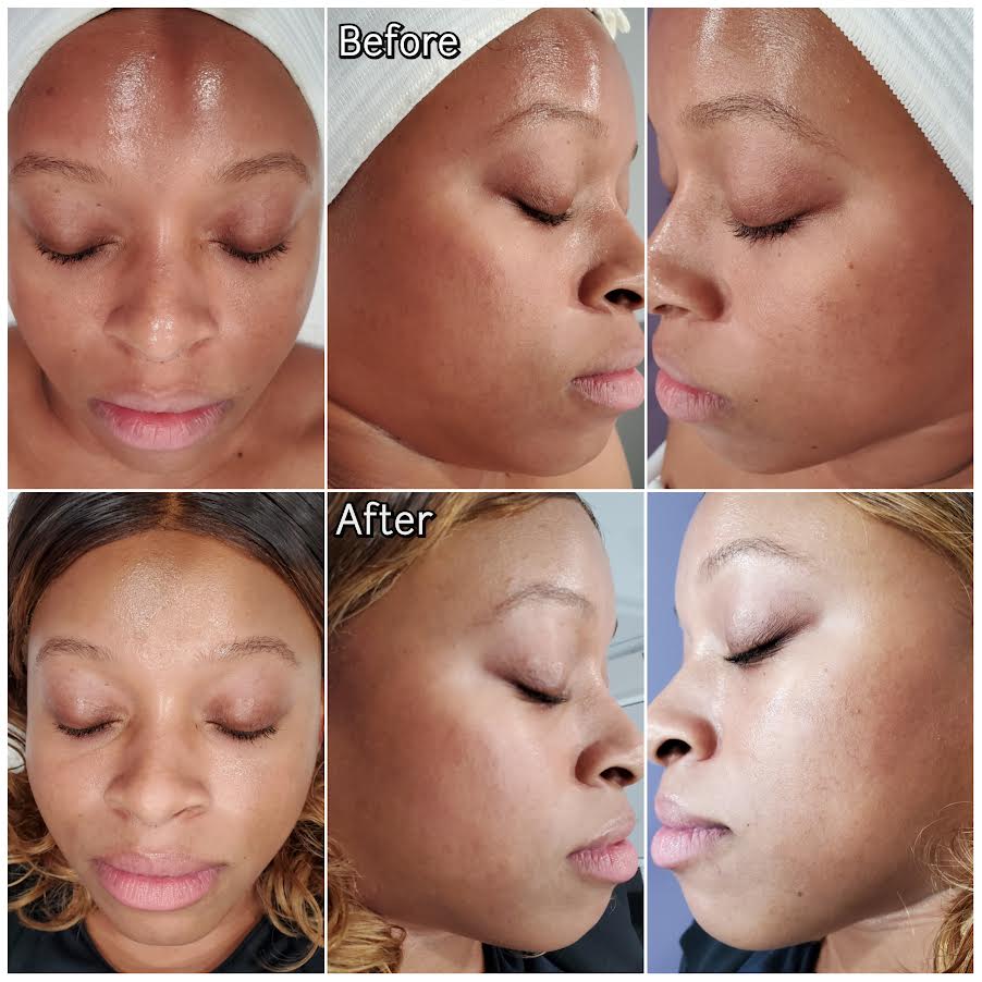 Perfect Derma Peel Before and After