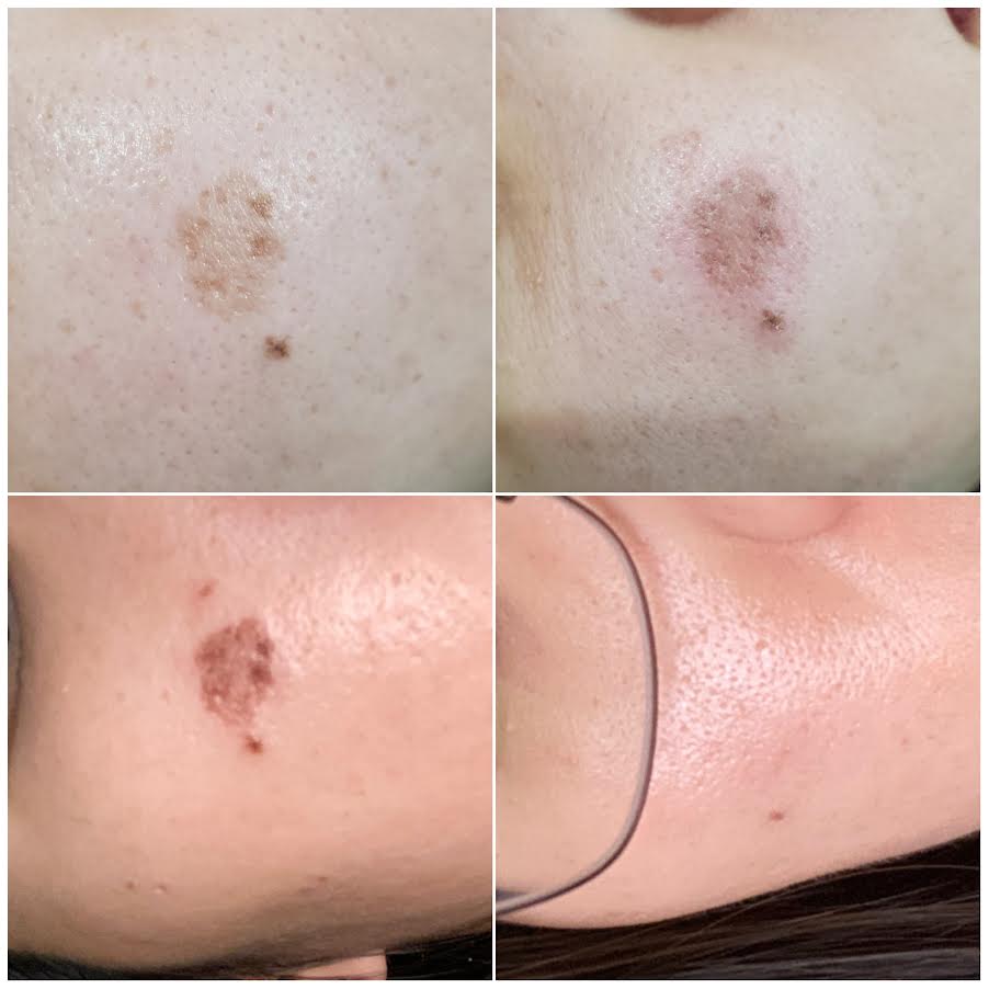 Aerolase Before and After