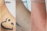 Picoway Tattoo Removal in Vienna VA | Sechoir Beauty Bar