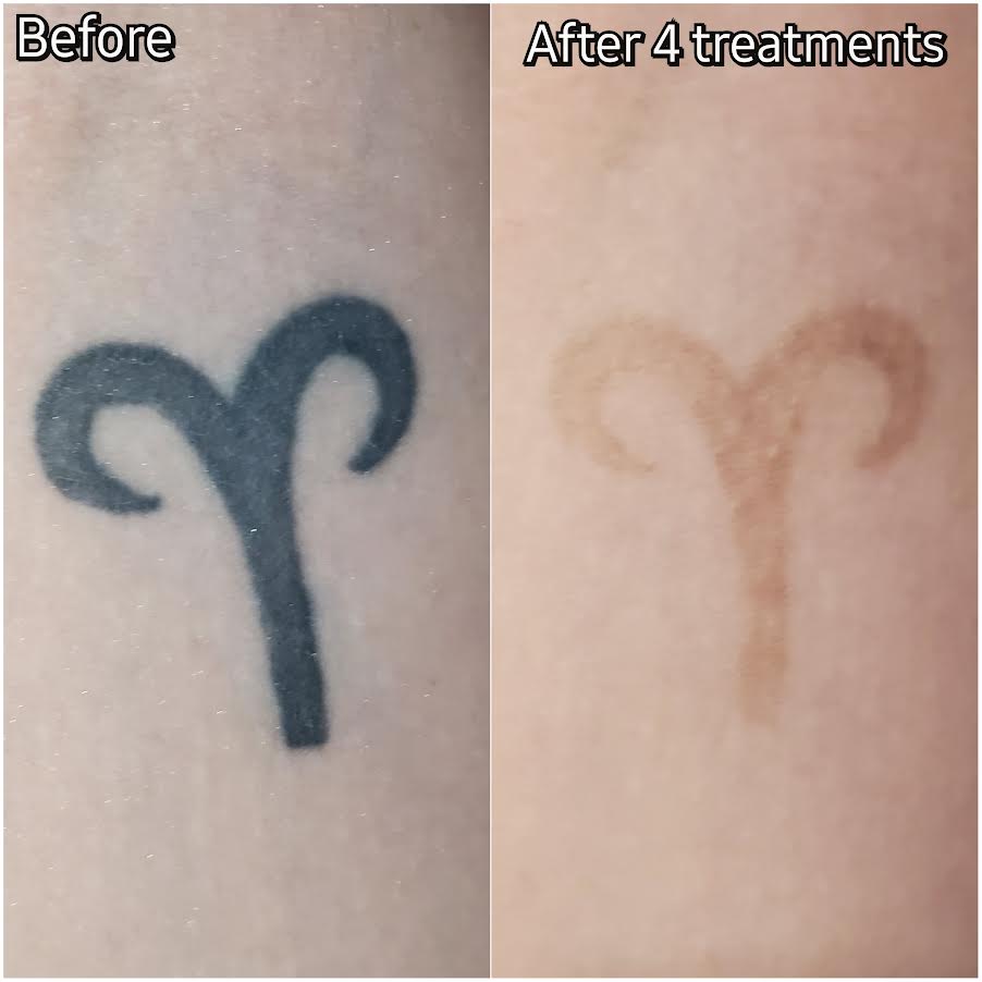 Picoway Tattoo Removal in Vienna VA | Sechoir Beauty Bar