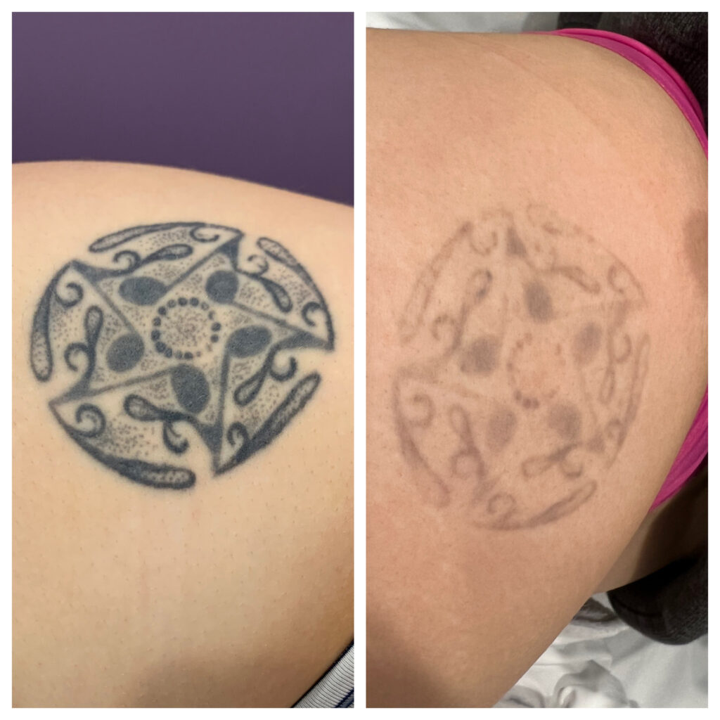 Tattoo Removal in Vienna VA | Sechoir Beauty Bar